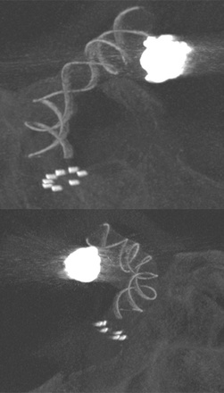 AComA-Crossover-Treatment-of-a-Complex-ICA-Tip-Aneurysm-Using-pEGASUS-HPC-stent-figure11