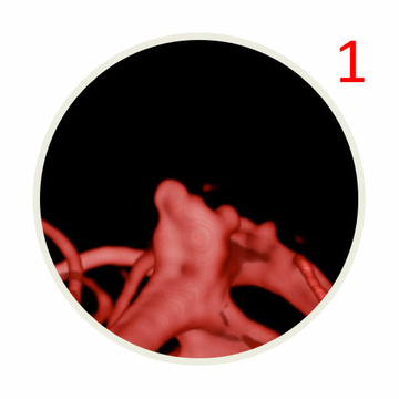 AComA-Crossover-Treatment-of-a-Complex-ICA-Tip-Aneurysm-Using-pEGASUS-HPC-stent-figure12-1
