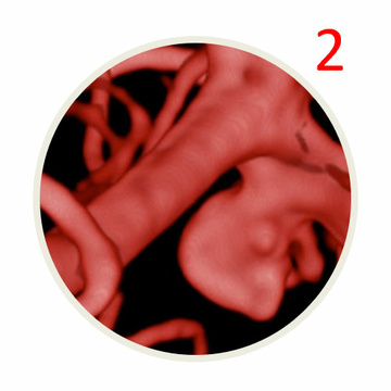 AComA-Crossover-Treatment-of-a-Complex-ICA-Tip-Aneurysm-Using-pEGASUS-HPC-stent-figure12-2