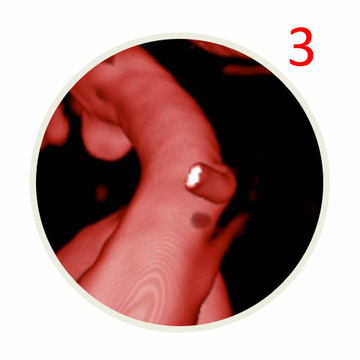 AComA-Crossover-Treatment-of-a-Complex-ICA-Tip-Aneurysm-Using-pEGASUS-HPC-stent-figure12-3