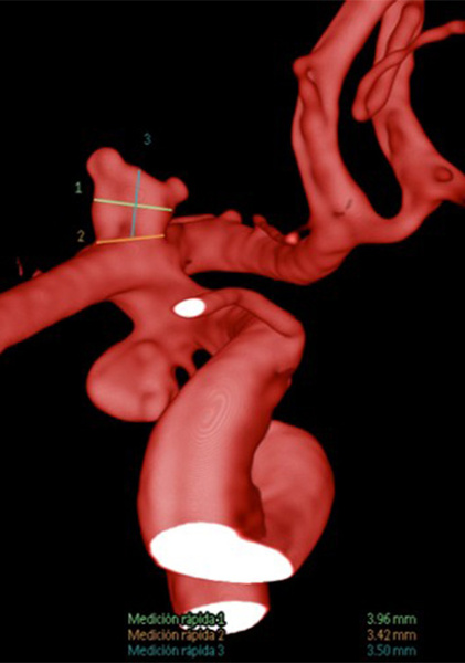 AComA-Crossover-Treatment-of-a-Complex-ICA-Tip-Aneurysm-Using-pEGASUS-HPC-stent-figure13