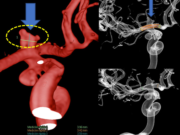 AComA-Crossover-Treatment-of-a-Complex-ICA-Tip-Aneurysm-Using-pEGASUS-HPC-stent-figure14