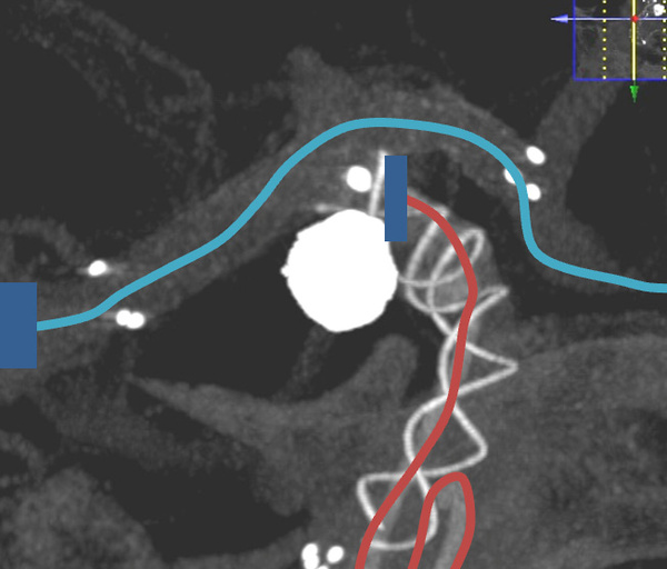 AComA-Crossover-Treatment-of-a-Complex-ICA-Tip-Aneurysm-Using-pEGASUS-HPC-stent-figure16