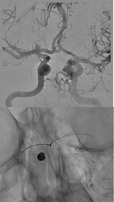 AComA-Crossover-Treatment-of-a-Complex-ICA-Tip-Aneurysm-Using-pEGASUS-HPC-stent-figure17