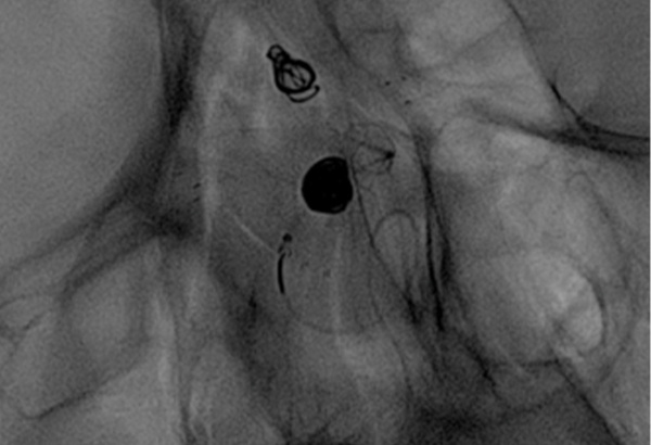 AComA-Crossover-Treatment-of-a-Complex-ICA-Tip-Aneurysm-Using-pEGASUS-HPC-stent-figure18-2