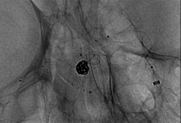 AComA-Crossover-Treatment-of-a-Complex-ICA-Tip-Aneurysm-Using-pEGASUS-HPC-stent-figure18