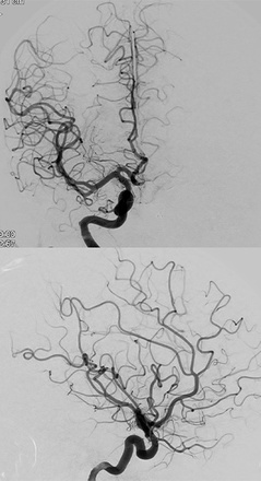 AComA-Crossover-Treatment-of-a-Complex-ICA-Tip-Aneurysm-Using-pEGASUS-HPC-stent-figure19