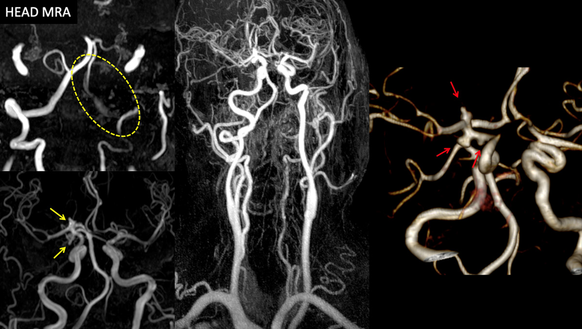 AComA-Crossover-Treatment-of-a-Complex-ICA-Tip-Aneurysm-Using-pEGASUS-HPC-stent-figure2