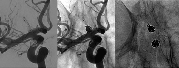AComA-Crossover-Treatment-of-a-Complex-ICA-Tip-Aneurysm-Using-pEGASUS-HPC-stent-figure20