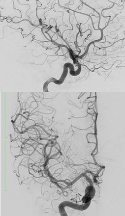 AComA-Crossover-Treatment-of-a-Complex-ICA-Tip-Aneurysm-Using-pEGASUS-HPC-stent-figure21