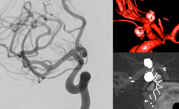 AComA-Crossover-Treatment-of-a-Complex-ICA-Tip-Aneurysm-Using-pEGASUS-HPC-stent-figure22