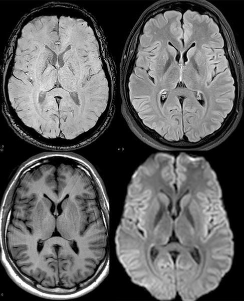 AComA-Crossover-Treatment-of-a-Complex-ICA-Tip-Aneurysm-Using-pEGASUS-HPC-stent-figure23