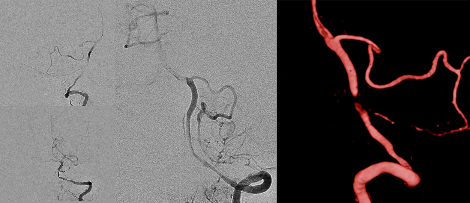 AComA-Crossover-Treatment-of-a-Complex-ICA-Tip-Aneurysm-Using-pEGASUS-HPC-stent-figure4