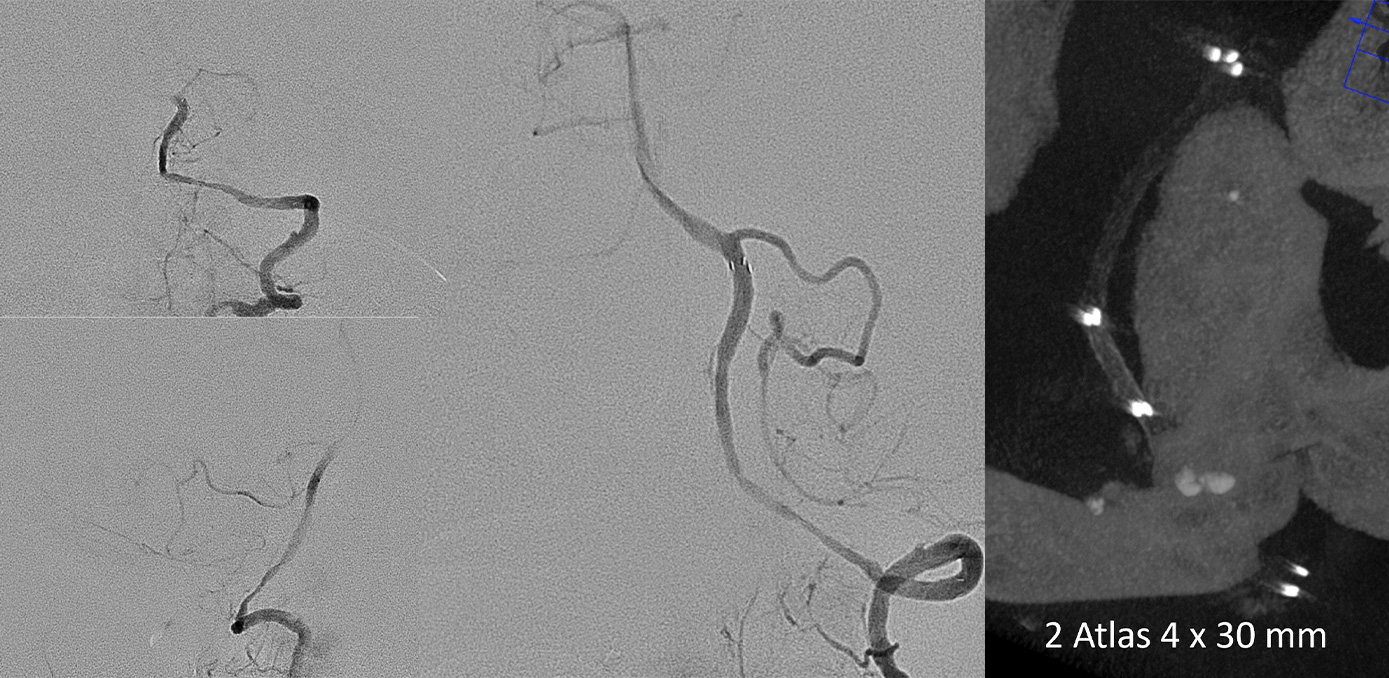 AComA-Crossover-Treatment-of-a-Complex-ICA-Tip-Aneurysm-Using-pEGASUS-HPC-stent-figure6