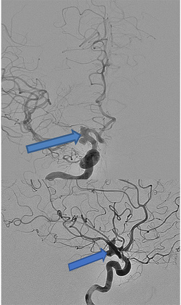AComA-Crossover-Treatment-of-a-Complex-ICA-Tip-Aneurysm-Using-pEGASUS-HPC-stent-figure7