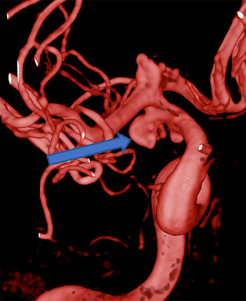 AComA-Crossover-Treatment-of-a-Complex-ICA-Tip-Aneurysm-Using-pEGASUS-HPC-stent-figure8