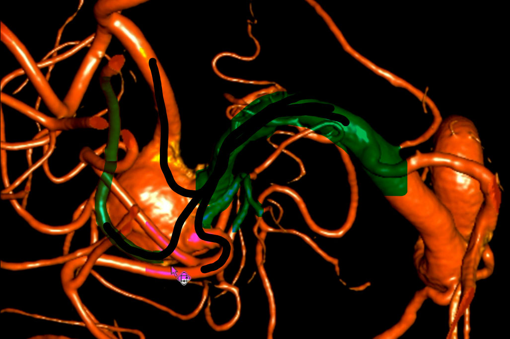 double-y-stenting-for-stent-assisted-coil-embolisation-using-3-pegasus-hpc-figure10