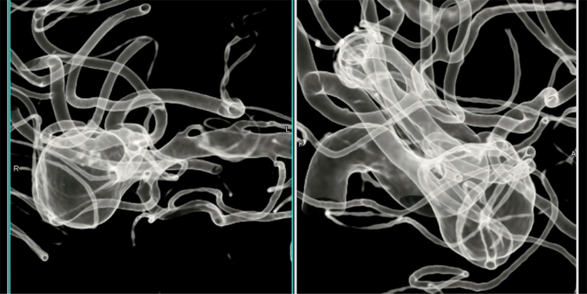 double-y-stenting-for-stent-assisted-coil-embolisation-using-3-pegasus-hpc-figure11