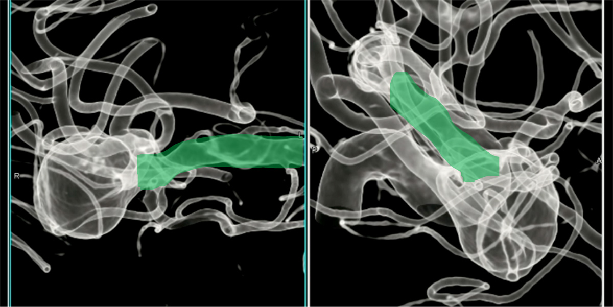 double-y-stenting-for-stent-assisted-coil-embolisation-using-3-pegasus-hpc-figure12