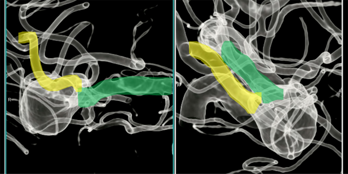 double-y-stenting-for-stent-assisted-coil-embolisation-using-3-pegasus-hpc-figure13