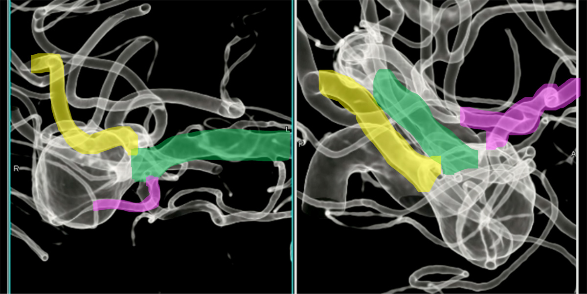 double-y-stenting-for-stent-assisted-coil-embolisation-using-3-pegasus-hpc-figure14