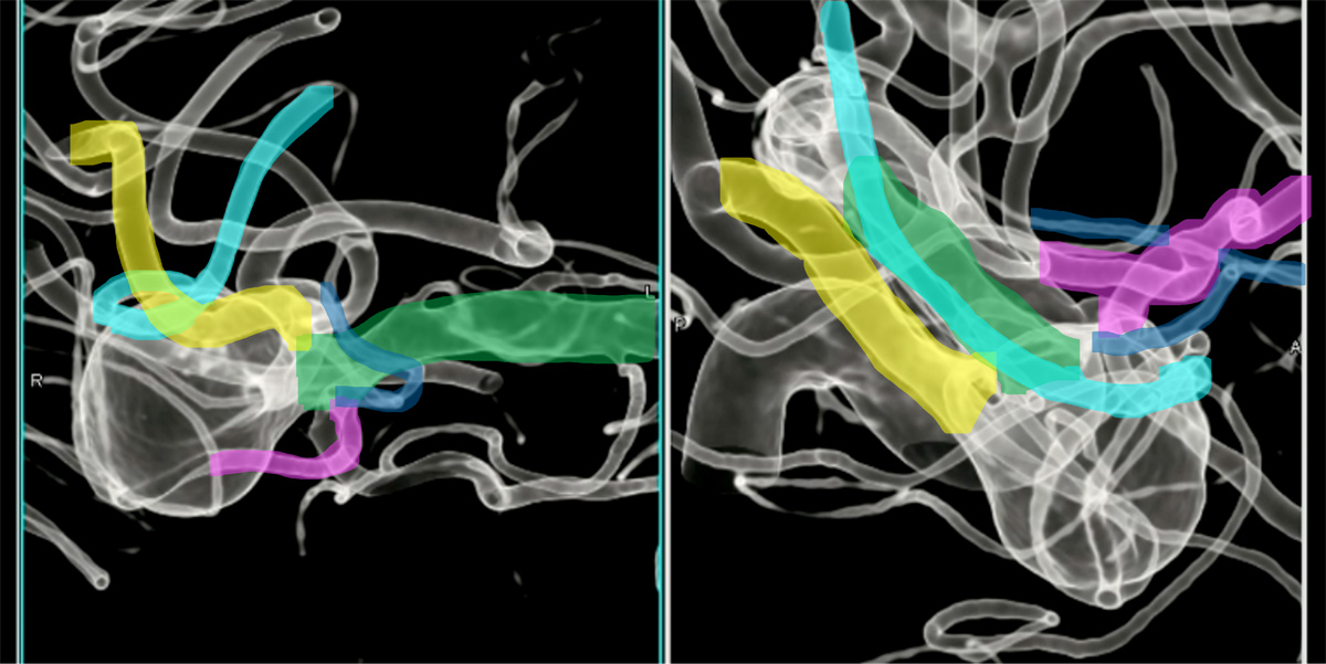double-y-stenting-for-stent-assisted-coil-embolisation-using-3-pegasus-hpc-figure16