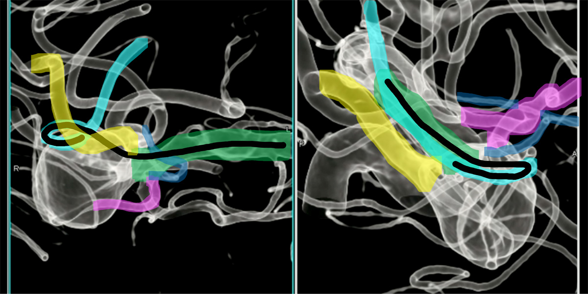 double-y-stenting-for-stent-assisted-coil-embolisation-using-3-pegasus-hpc-figure17