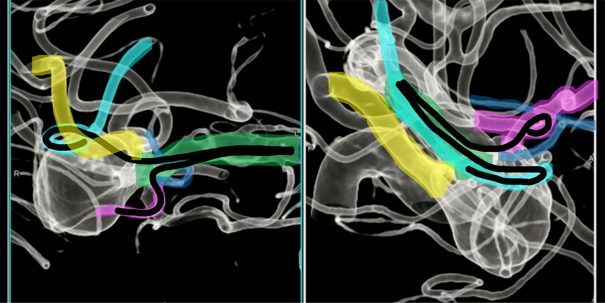 double-y-stenting-for-stent-assisted-coil-embolisation-using-3-pegasus-hpc-figure18