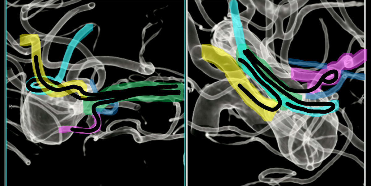 double-y-stenting-for-stent-assisted-coil-embolisation-using-3-pegasus-hpc-figure19