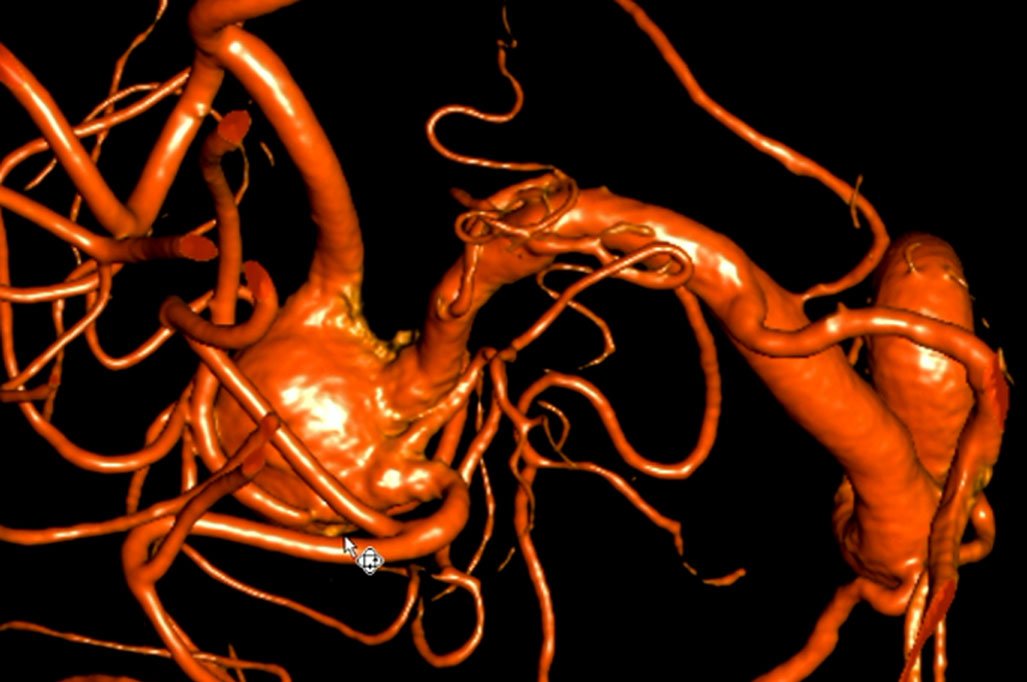 double-y-stenting-for-stent-assisted-coil-embolisation-using-3-pegasus-hpc-figure2