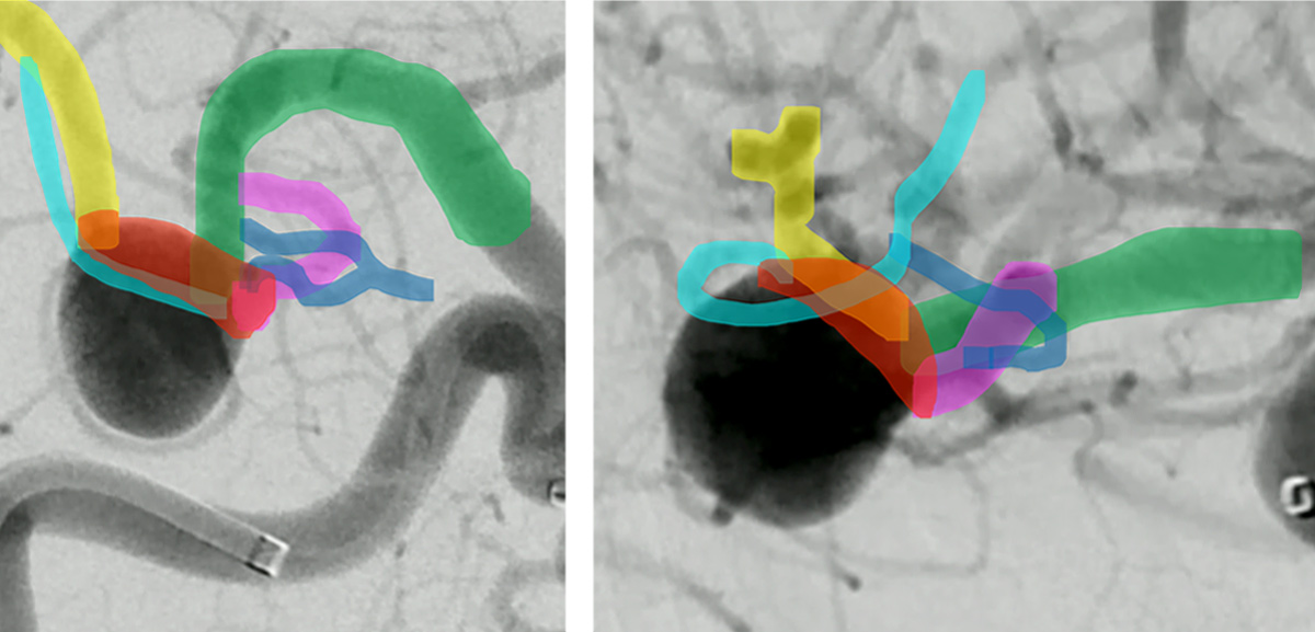 double-y-stenting-for-stent-assisted-coil-embolisation-using-3-pegasus-hpc-figure20