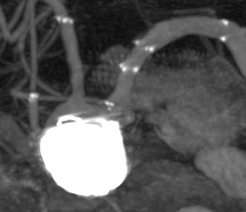 double-y-stenting-for-stent-assisted-coil-embolisation-using-3-pegasus-hpc-figure21