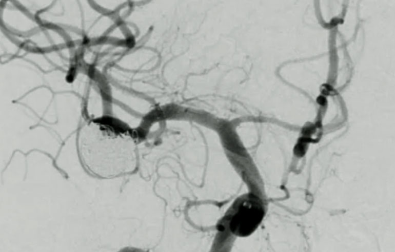 double-y-stenting-for-stent-assisted-coil-embolisation-using-3-pegasus-hpc-figure22