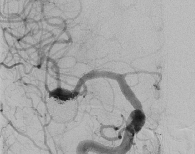 double-y-stenting-for-stent-assisted-coil-embolisation-using-3-pegasus-hpc-figure23