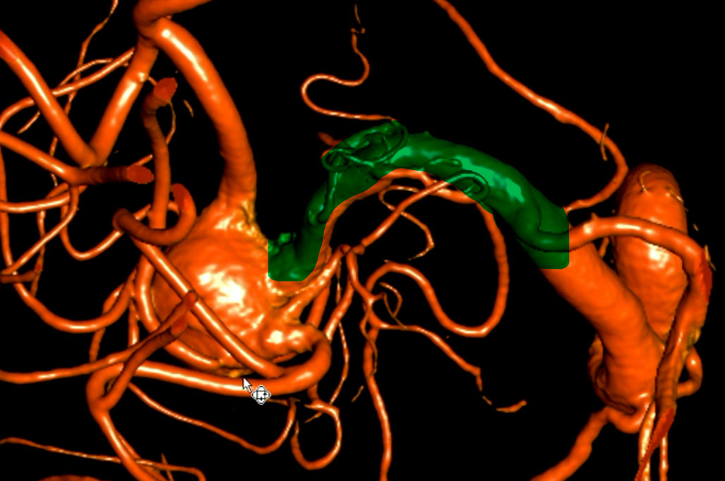 double-y-stenting-for-stent-assisted-coil-embolisation-using-3-pegasus-hpc-figure3