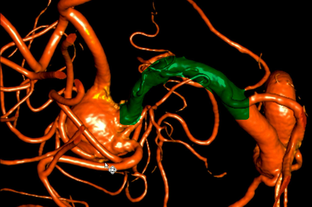 double-y-stenting-for-stent-assisted-coil-embolisation-using-3-pegasus-hpc-figure4