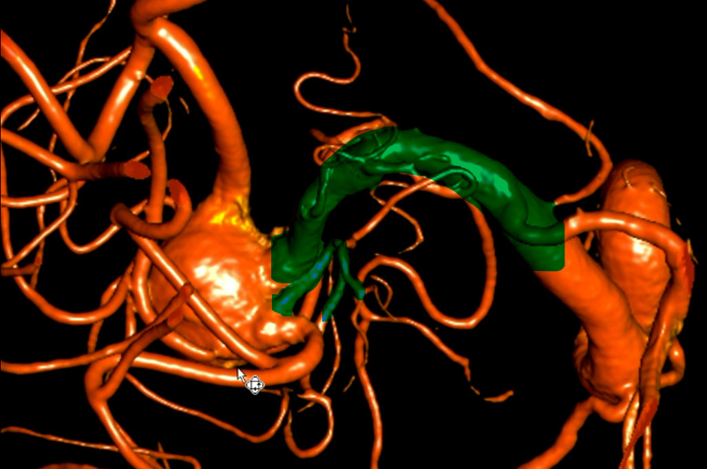 double-y-stenting-for-stent-assisted-coil-embolisation-using-3-pegasus-hpc-figure5