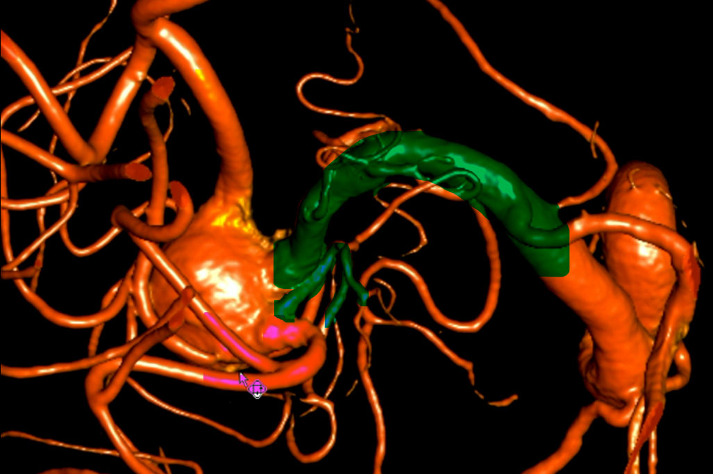 double-y-stenting-for-stent-assisted-coil-embolisation-using-3-pegasus-hpc-figure6