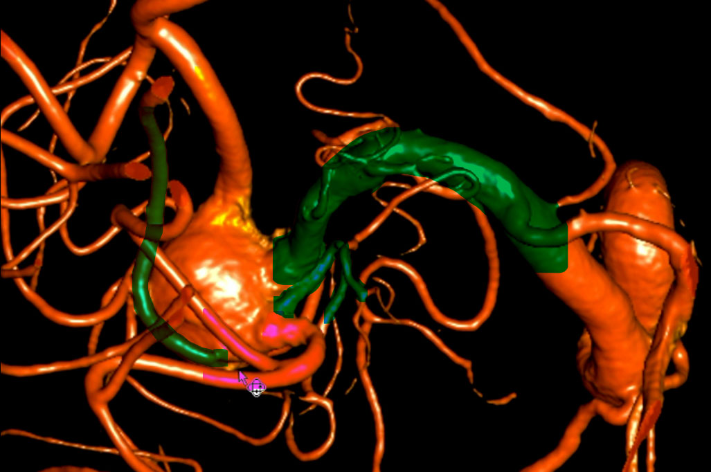 double-y-stenting-for-stent-assisted-coil-embolisation-using-3-pegasus-hpc-figure7