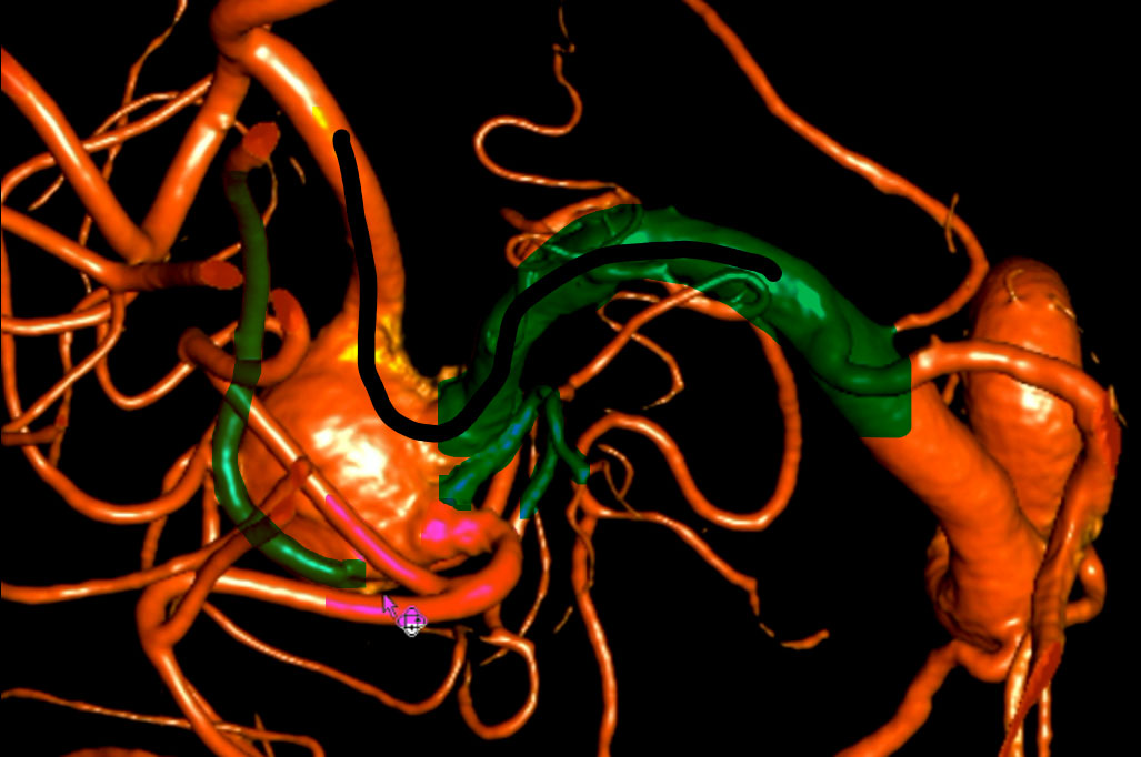 double-y-stenting-for-stent-assisted-coil-embolisation-using-3-pegasus-hpc-figure8