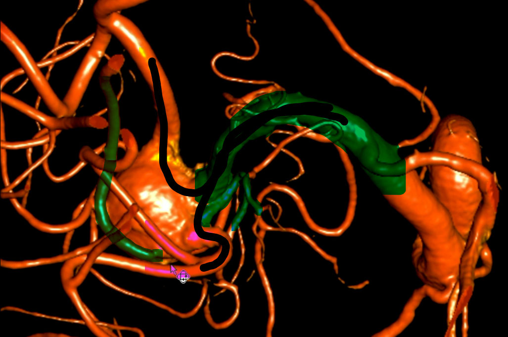 double-y-stenting-for-stent-assisted-coil-embolisation-using-3-pegasus-hpc-figure9