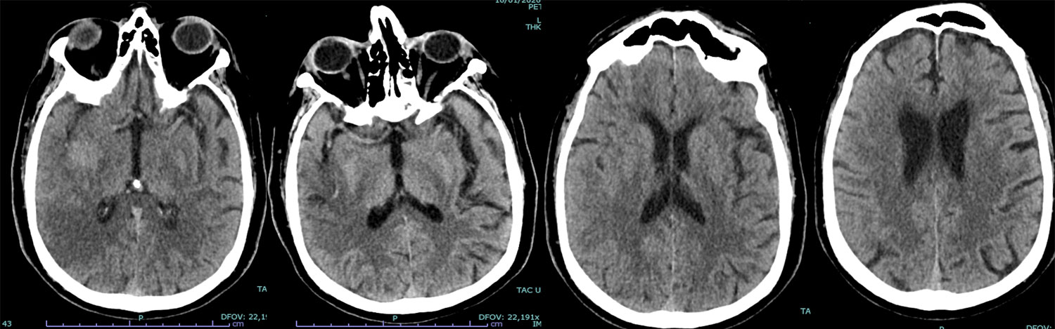elective-thrombectomy-with-combined-technique-in-m2-occlusion-figure1