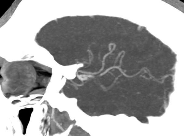 elective-thrombectomy-with-combined-technique-in-m2-occlusion-figure2