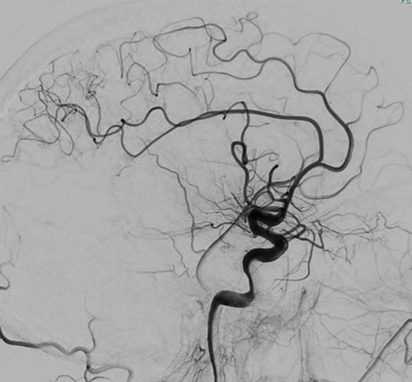 elective-thrombectomy-with-combined-technique-in-m2-occlusion-figure5