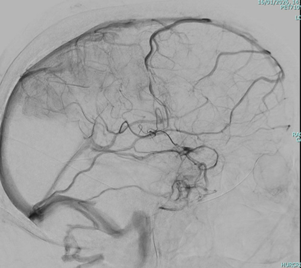 elective-thrombectomy-with-combined-technique-in-m2-occlusion-figure6