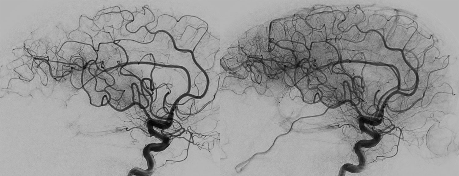 elective-thrombectomy-with-combined-technique-in-m2-occlusion-figure7