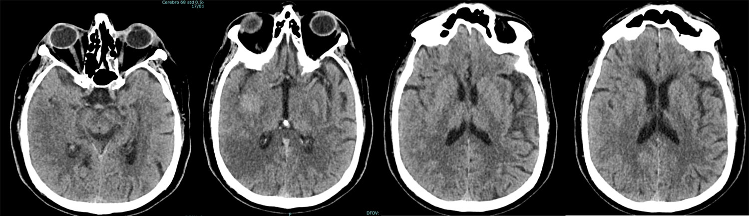 elective-thrombectomy-with-combined-technique-in-m2-occlusion-figure8