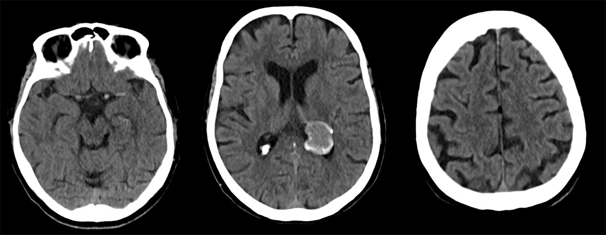 First-Pass Complete Reperfusion in a Left Carotid-T Occlusion Using an Aspiration Catheter and XL Delivery Catheter - Figure 1