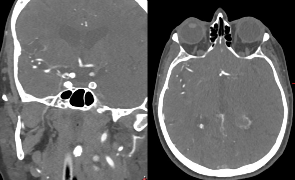 First-Pass Complete Reperfusion in a Left Carotid-T Occlusion Using an Aspiration Catheter and XL Delivery Catheter - Figure 2
