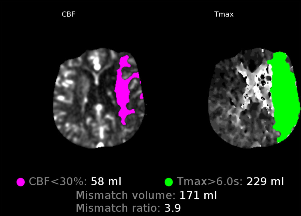 First-Pass Complete Reperfusion in a Left Carotid-T Occlusion Using an Aspiration Catheter and XL Delivery Catheter - Figure 3